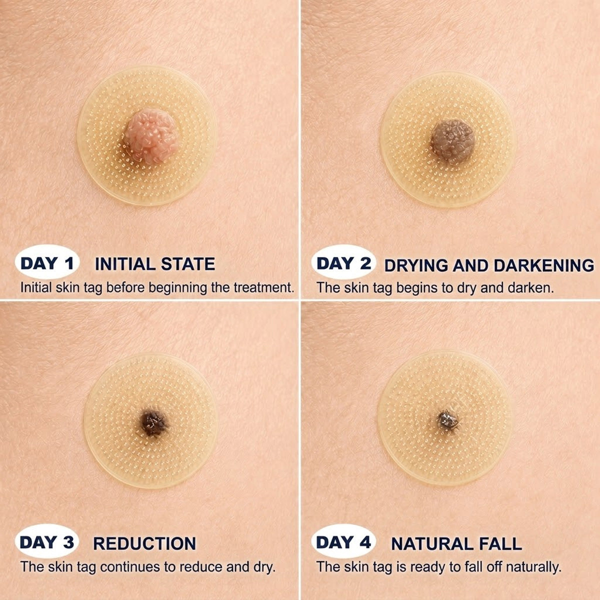 👩‍⚕️🎉 Official Flagship Store | CureVivo® 🐝 Microneedle Patch with Bee Venom (for warts, age spots, and blemishes)