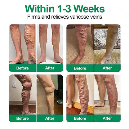 🇺🇸👨‍⚕️👍✅Healrize® VeinTarget Microneedle Patch⚡Instant Relief, Long-Term Results🗽