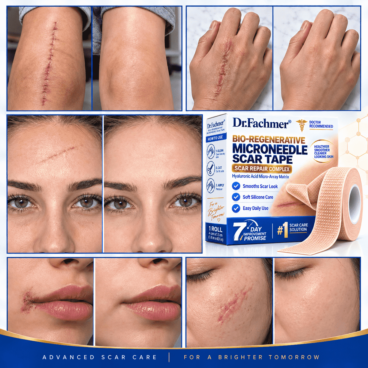 🥳 𝐎𝐟𝐟𝐢𝐜𝐢𝐚𝐥 𝐒𝐭𝐨𝐫𝐞丨Dr.Fachmer® 🩹 Bio-Regenerative Microneedle Scar Tape——Remove all kinds of skin scars