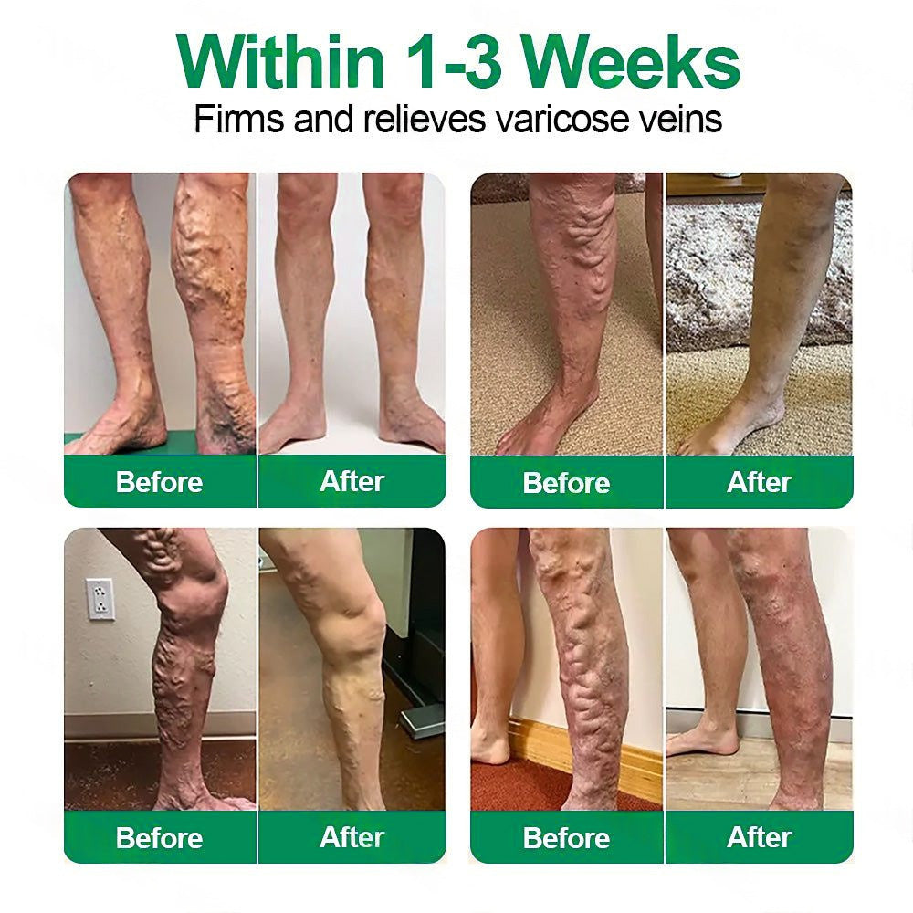🇺🇸👨‍⚕️✅𝐇𝐞𝐚𝐥𝐫𝐢𝐳𝐞® VenoEase Soluble Microneedle Patch⚡Instant Relief, Long-Term Results ⚡