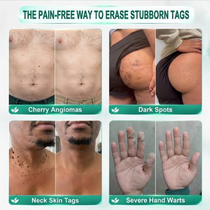 🔥 𝐎𝐟𝐟𝐢𝐜𝐢𝐚𝐥 𝐒𝐭𝐨𝐫𝐞 | Healrize®  🍃𝐁𝐨𝐭𝐚𝐧𝐢𝐜𝐚𝐥 𝐌𝐢𝐜𝐫𝐨𝐧𝐞𝐞𝐝𝐥𝐞 𝐇𝐲𝐝𝐫𝐨𝐜𝐨𝐥𝐥𝐨𝐢𝐝 𝐏𝐚𝐭𝐜𝐡 (𝐅𝐨𝐫 𝐒𝐤𝐢𝐧 𝐓𝐚𝐠𝐬, 𝐒𝐦𝐚𝐥𝐥 𝐒𝐤𝐢𝐧 𝐆𝐫𝐨𝐰𝐭𝐡𝐬, 𝐖𝐚𝐫𝐭𝐬, 𝐌𝐨𝐥𝐞𝐬, 𝐀𝐠𝐞 𝐒𝐩𝐨𝐭𝐬 & 𝐏𝐢𝐠𝐦𝐞𝐧𝐭𝐚𝐭𝐢𝐨𝐧 𝐂𝐨𝐧𝐜𝐞𝐫𝐧𝐬)