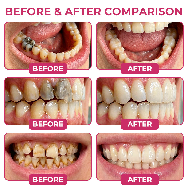 🇺🇸GarageLine® DenPerm Cavity-Repair Natural Enamel Filling Gel